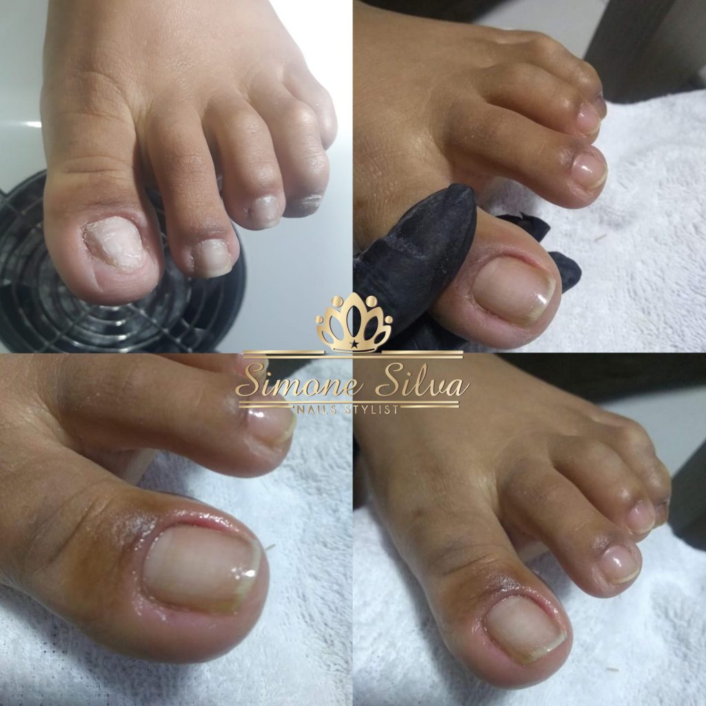 Transformação da unha do dedão do pé INCRÍVEL - Simone Silva Nails